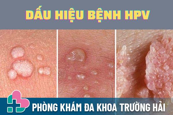 Dấu hiệu nhận biết của bệnh HPV