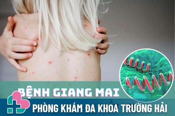 Bệnh giang mai là gì? Biểu hiện và cách chữa trị hiệu quả