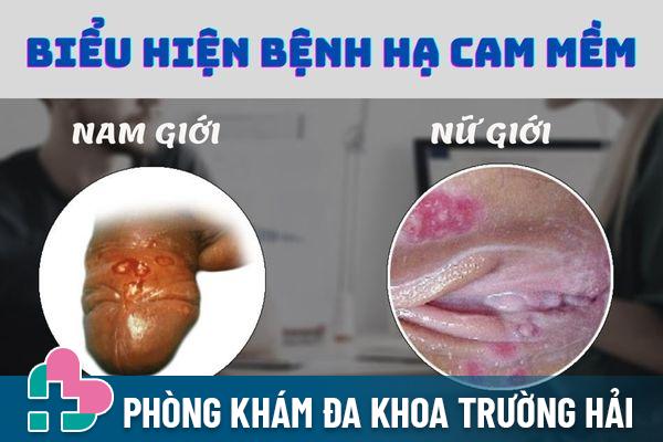 Biểu hiện của bệnh hạ cam mềm