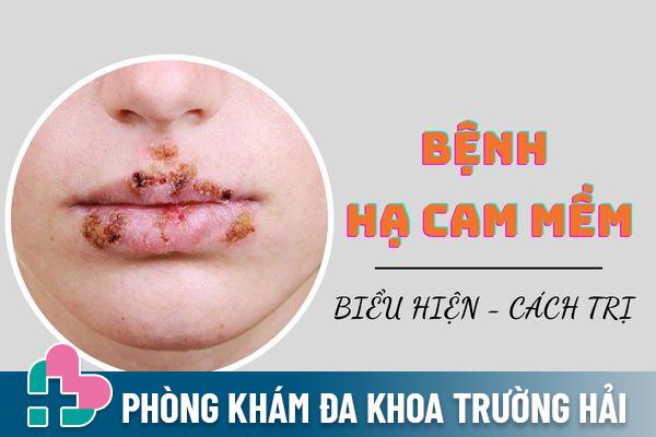 Bệnh hạ cam mềm là gì? Nguyên nhân và hướng điều trị hiệu quả