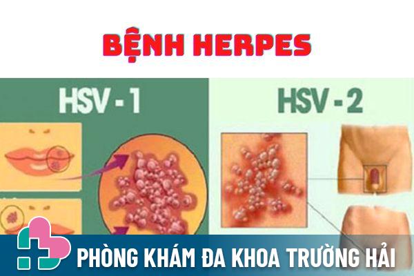 Bệnh Herpes phổ biến ở cả nam và nữ