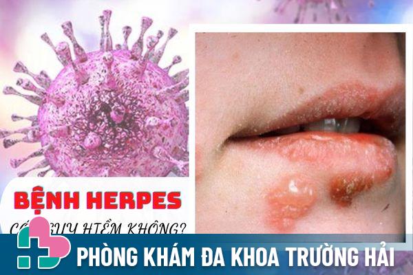 Bệnh Herpes sinh dục là gì? Có nguy hiểm không?