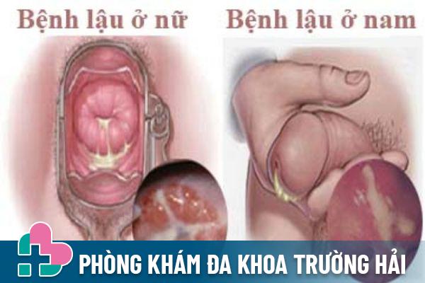 Dấu hiệu nhận biết bệnh lậu ở nam và nữ giới