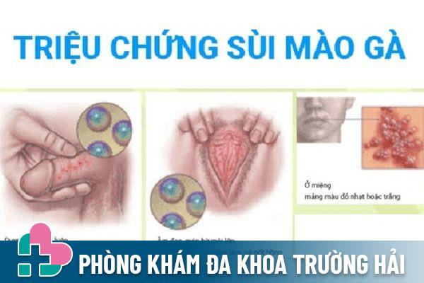 Bệnh sùi mào gà có thể gặp ở cả nam và nữ