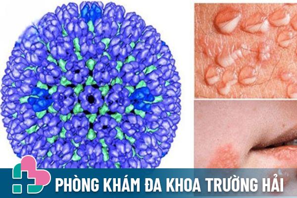 Bệnh mụn rộp sinh dục do virus HSV gây ra