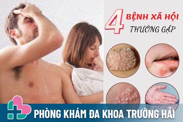 Top 4 bệnh xã hội thường gặp nhất – Cách điều trị hiệu quả