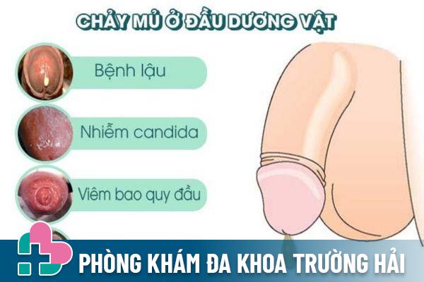 Chảy mủ ở nam giới cảnh báo nhiều bệnh lý khác nhau