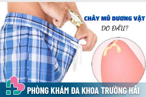 Nguyên nhân chảy mủ ở nam giới – Cách điều trị hiệu quả