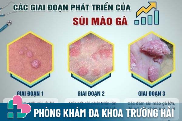 Các giai đoạn phát triển của bệnh sùi mào gà