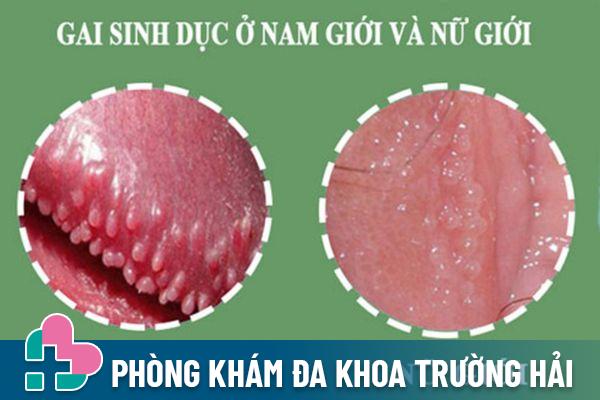 Gai sinh dục có thể gặp phải ở cả nam và nữ