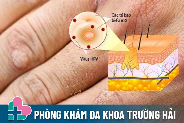 Mụn cơm là bệnh ngoài da do virus HPV gây nên