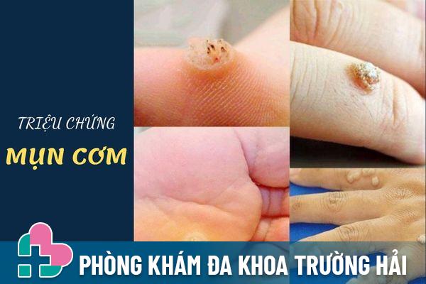 Triệu hứng nhận biết mụn cơm