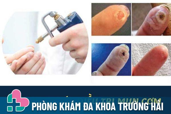 Phương pháp điều trị mụn cơm hiệu quả