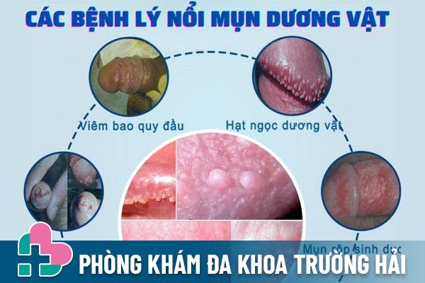 Các bệnh lý khiến dương vật nổi mụn