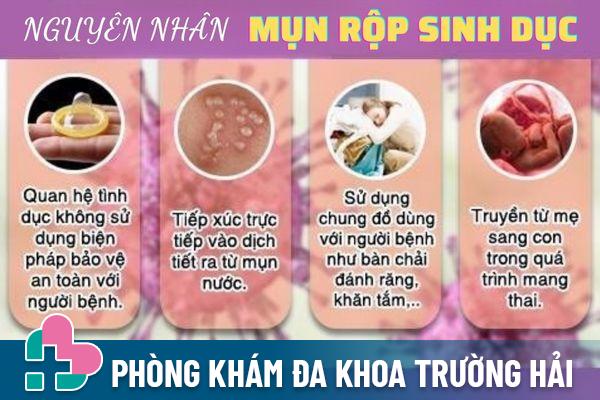 Nguyên nhân gây bệnh mụn rộp sinh dục