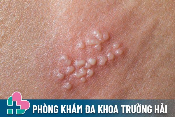 Mụn rộp sinh dục là bệnh xã hội khá nguy hiểm