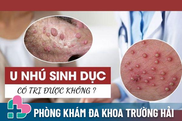 U Nhú Sinh Dục là gì? Có điều trị được không?