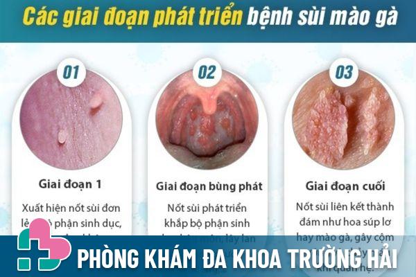 Sùi mào gà có những biểu hiện nhận biết tùy vào từng giai đoạn khác nhau