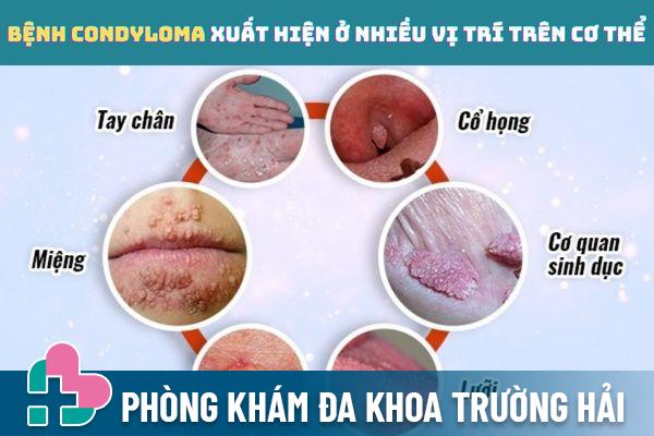 Bệnh Condyloma xuất hiện ở nhiều vị trí trên cơ thể