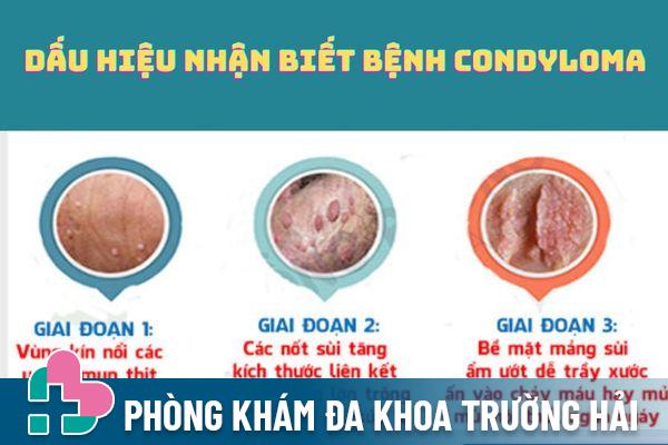 Các triệu chứng nhận biết bệnh Condyloma phổ biến