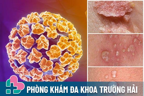 HPV là tác nhân chính gây bệnh sùi mào gà