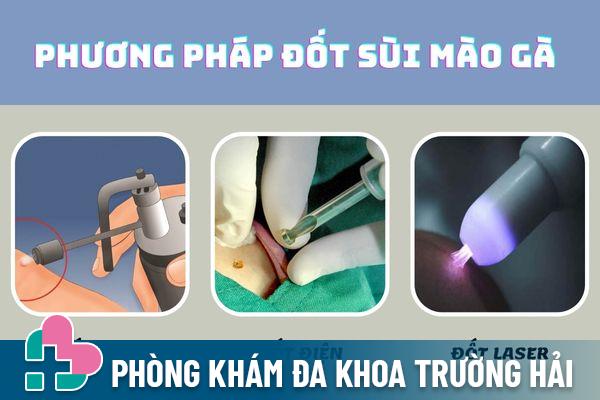 Phương pháp ddotsosuif mào gà loại bỏ virus HPV hiệu quả