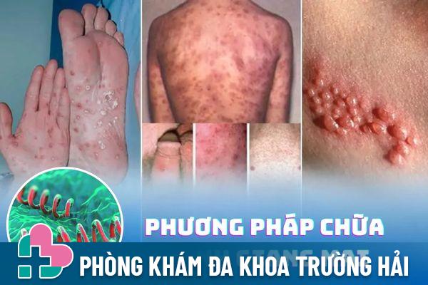 Phương pháp chữa bệnh giang mai hiệu quả – Chi phí điều trị bao nhiêu?