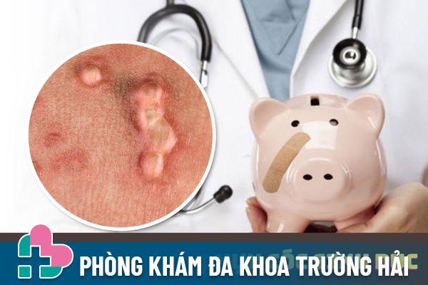 Chi phí điều trị mụn cóc sinh dục bao nhiêu tiền?