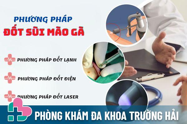 Một số phương pháp đốt sùi mào gà phổ biến hiện nay