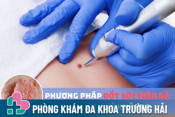 Phương pháp đốt sùi mào gà có hiệu quả không?