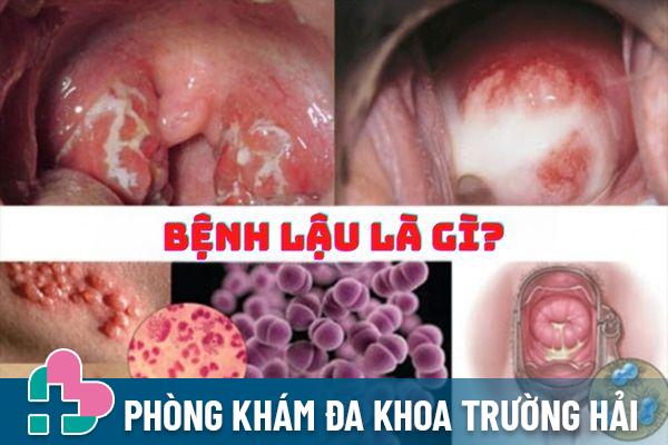 Lậu là bệnh xã hội khá phổ biến hiện nay