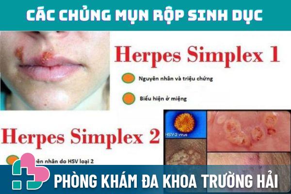 Virus HSV là tác nhân chính gây ra bệnh mụn rộp sinh dục