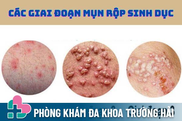 Mụn rộp sinh dục trải qua nhiều giai đoạn phát triển