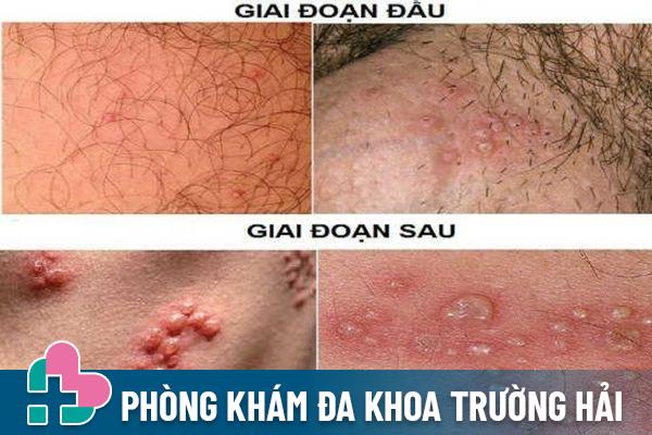 Dấu hiệu nhận biết mụn rộp sinh dục ở nam giới