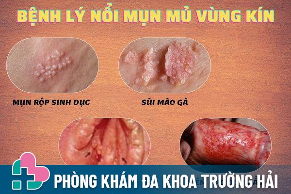 Bệnh lý gây nổi mụn mủ vùng kín