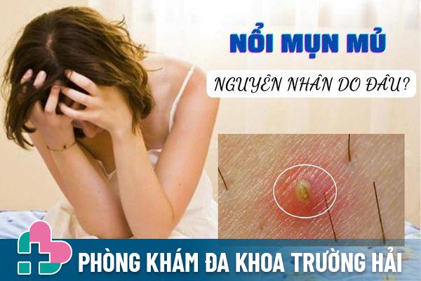 Nổi mụn mủ vùng kín: Nguyên nhân, triệu chứng và cách điều trị