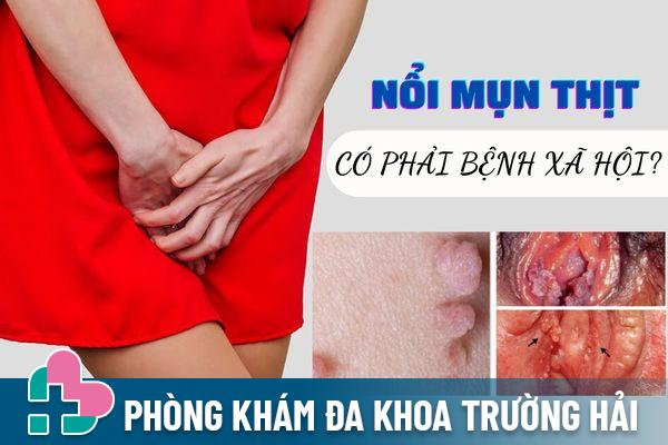 Nổi mụn thịt ở vùng kín có phải mắc bệnh xã hội không?