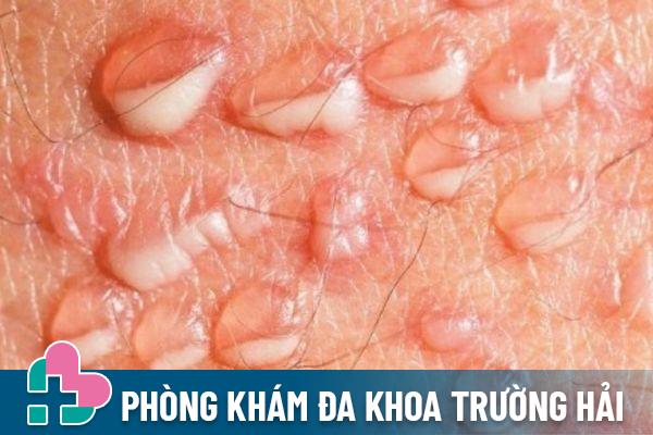 Nốt sần vùng kín là dấu hiệu của bệnh mụn rộp sinh dục