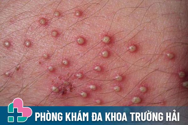 Nốt sần vùng kín là triệu chứng nhận biết bệnh viêm nang lông