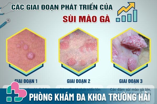 Quan hệ bằng miệng dễ lây nhiễm bệnh sùi mào gà