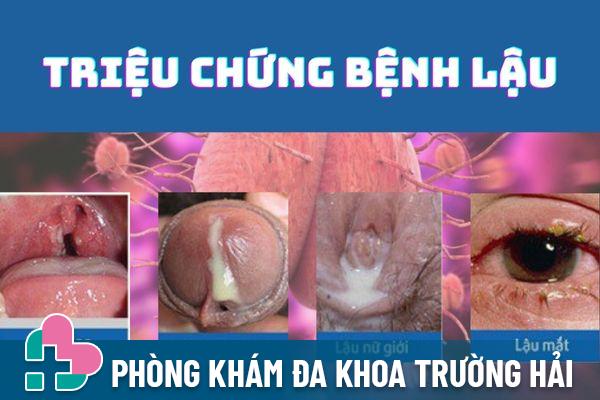 Bệnh sùi mào gà có thể lây nhiễm khi quan hệ bằng miệng