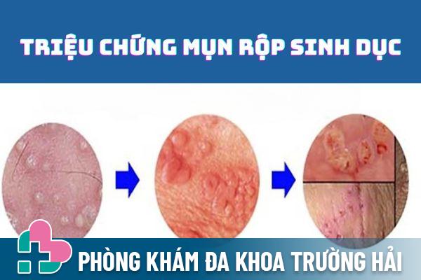 Triệu chứng bệnh mụn rộp sinh dục qua từng giai đoạn