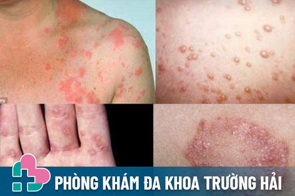 Lậu là bệnh xã hội phổ biến lây nhiễm qua quan hệ không an toàn