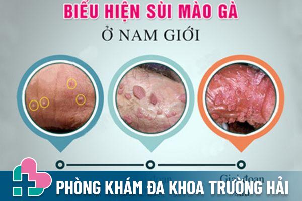 Sùi mào gà là bệnh lý dễ dàng phát sinh nếu quan hệ gái mại dâm