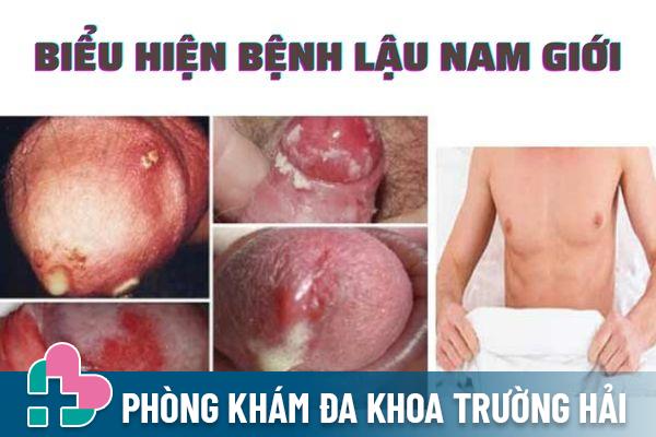 Triệu chứng bệnh lậu thường gặp ở nam giới