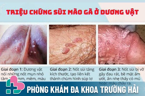 Triệu chứng của sùi mào gà ở dương vật