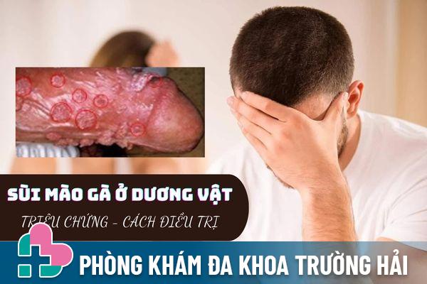 Sùi mào gà ở dương vật – Dấu hiệu nhận biết và cách điều trị