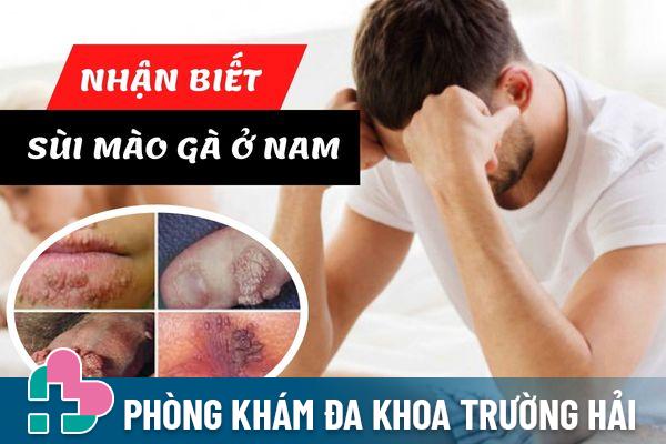 Dấu hiệu nhận biết sùi mào gà ở nam – Cách điều trị hiệu quả