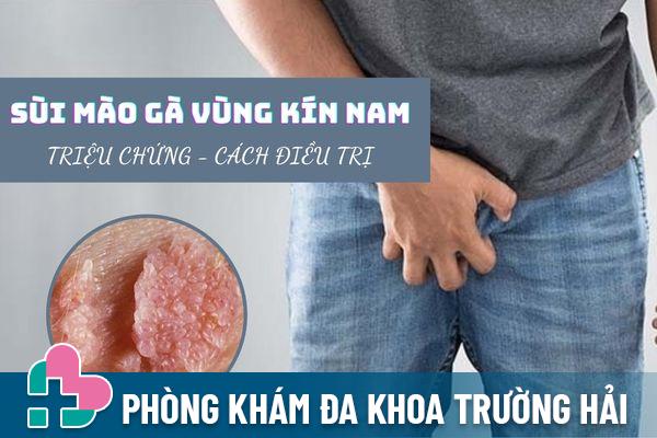 Sùi mào gà vùng kín nam – Triệu chứng và cách điều trị hiệu quả