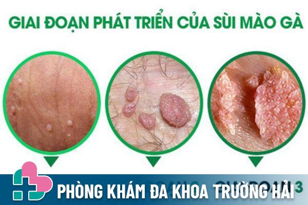 Biểu hiện của bệnh sùi mào gà qua từng giai đoạn